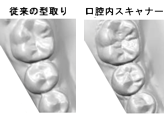 シリコン印象(PVS印象)対口腔内スキャナー(iTero element) シリコン印象(PVS印象)対口腔内スキャナー(iTero element)