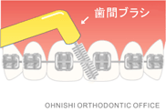ワイヤー下のブラッシング（歯間ブラシ）