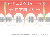 ミニスクリュー　上顎前歯の圧下