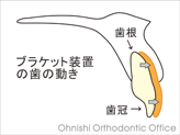 ブラケット装置の歯の動き