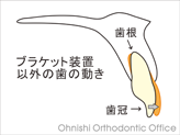 ブラケット装置以外の歯の動き