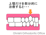 部分矯正（治療前）