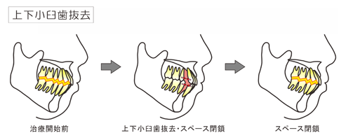 上下小臼歯抜去