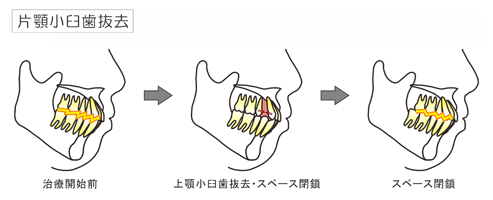 片顎小臼歯抜去