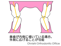 舌側傾斜の状態