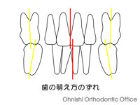 歯の萌え方のずれ