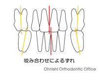 咬み合わせによるずれ