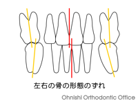 左右の骨の形態のずれ