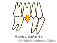 反対側の歯が挺出