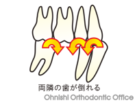 両隣の歯が傾斜