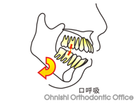 口呼吸