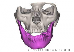 顎偏位CT画像
