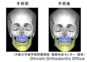 外科矯正3DSTO_正面