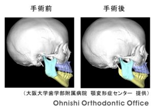 外科矯正3DSTO_側方