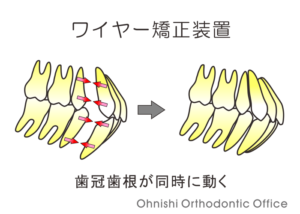 抜歯ケース（ワイヤー矯正装置）