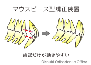 抜歯ケース（インビザライン）