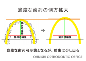 適度な歯列の側方拡大