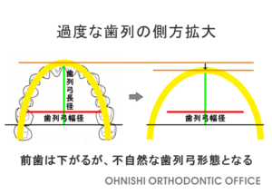 過度な歯列の側方拡大